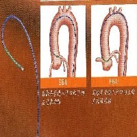 椎动脉造影导管图1