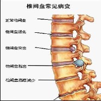 洛阳颈椎病|颈椎病自我治疗|洛阳椎管狭窄|省工疗疼痛科