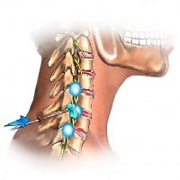 省工疗疼痛科|洛阳疼痛专科|颈椎病的预防及并发症图1