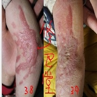 规模最大的祛疤痕_泸州祛红血丝