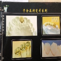 青岛哪里做烤瓷牙最专业 青岛烤瓷牙种类【首推】 圣迪安